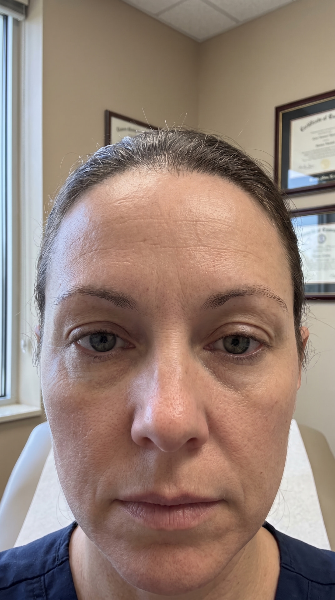 Testa com linhas suavizadas após a aplicação de botox