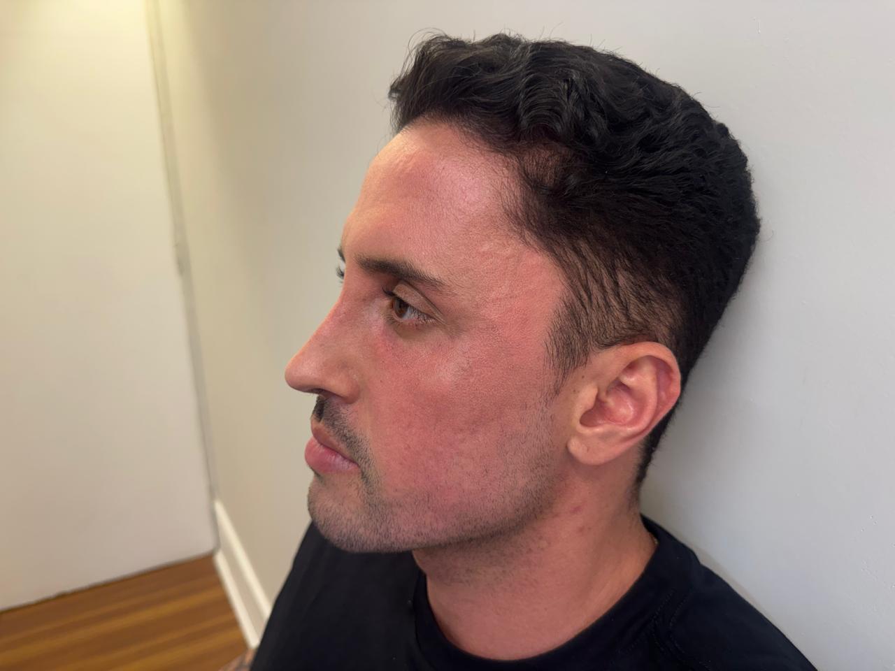 Rosto masculino com pele clara, uniforme e luminosa após o peeling