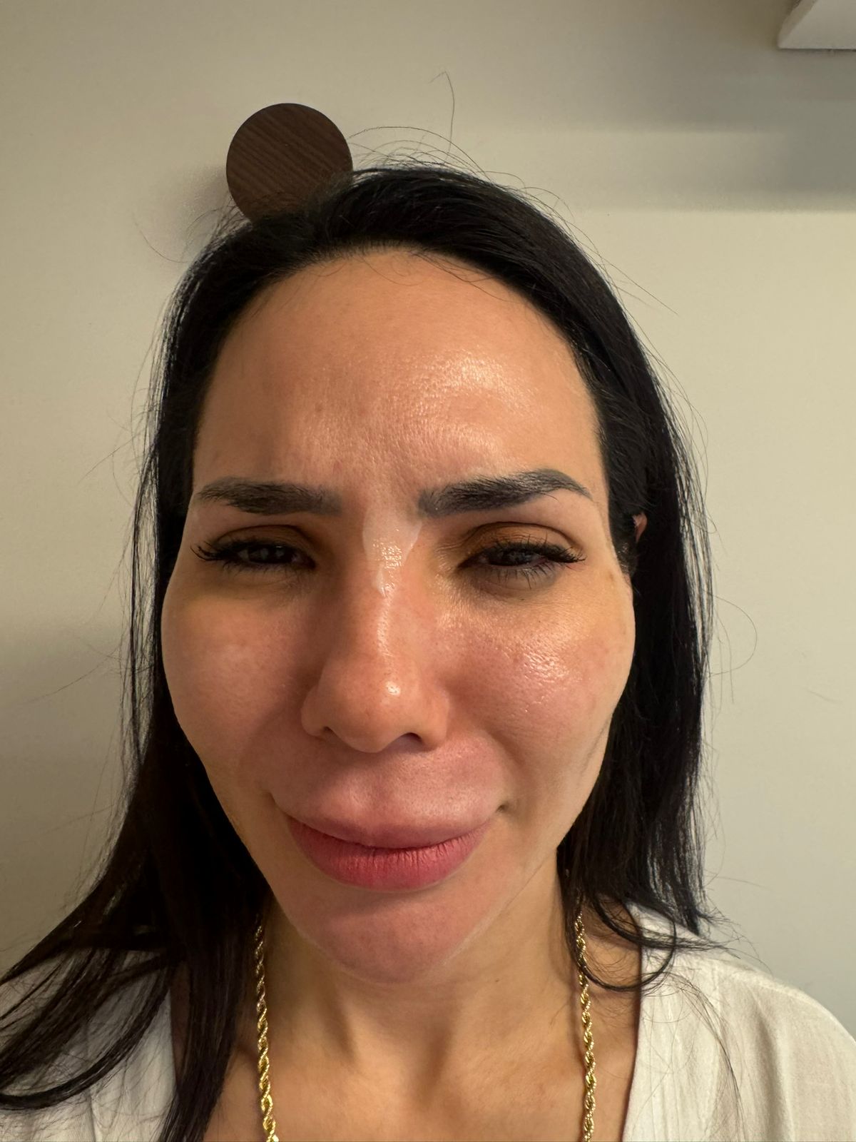Rosto feminino com linhas de expressão na testa após a harmonização facial