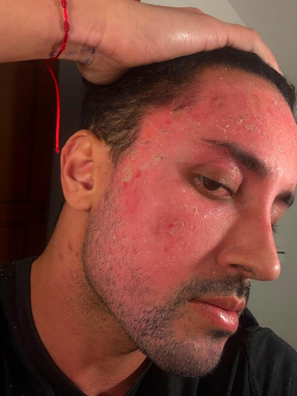 Rosto masculino com acne inflamada e vermelhidão antes do peeling