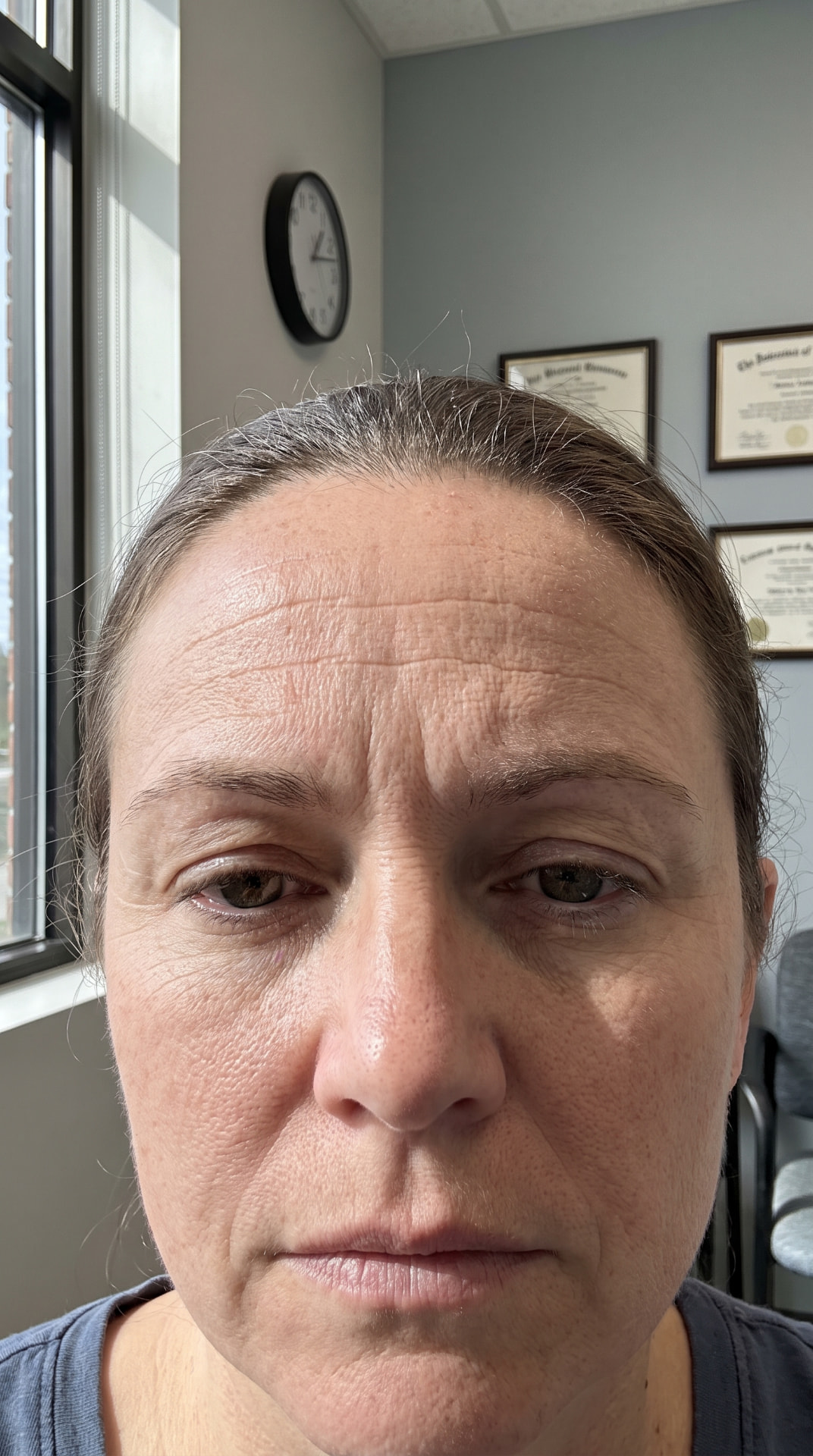 Testa com linhas de expressão marcadas antes da aplicação de botox